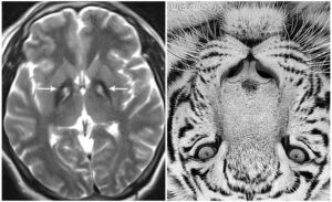 RM potenciada en T2. Signo del ojo de tigre. Región central hiperintensa (blanca), rodeada de zona hipointensa (negra) en el globo pálido. 